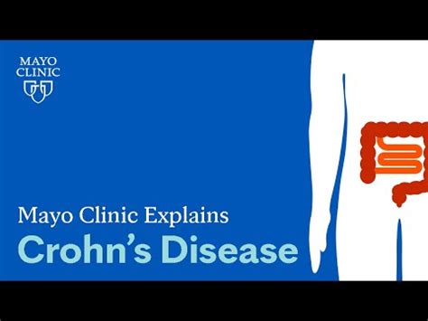 , MD, of the Mayo Clinic. . Crohns disease mayo clinic